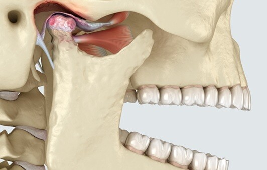 BZN401 Kiefergelenksprobleme_3